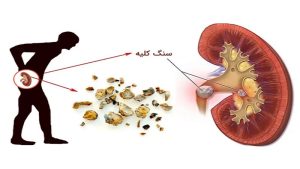 خواص ضد سنگ کلیه گز | گز و شیرینی آریا | بهترین گز اصفهان