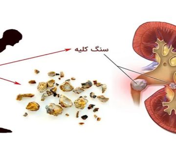خواص ضد سنگ کلیه گز | گز و شیرینی آریا | بهترین گز اصفهان